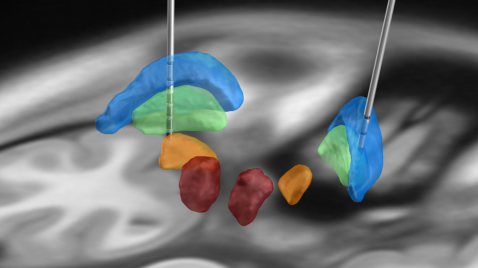 L'illustration montre l'utilisation de deux électrodes SCP dans la zone du globus pallidus interne (marqué en vert) pour traiter une dystonie.