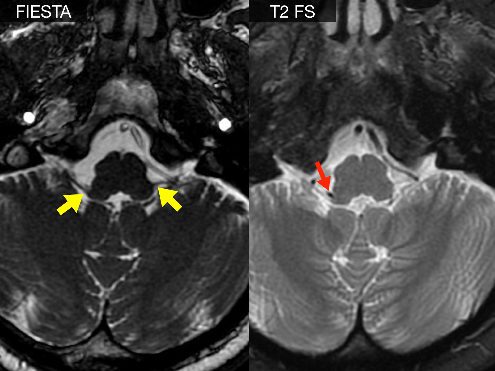 ​MRI des Schädels mit Markierung des neurovaskulären Konflikts
