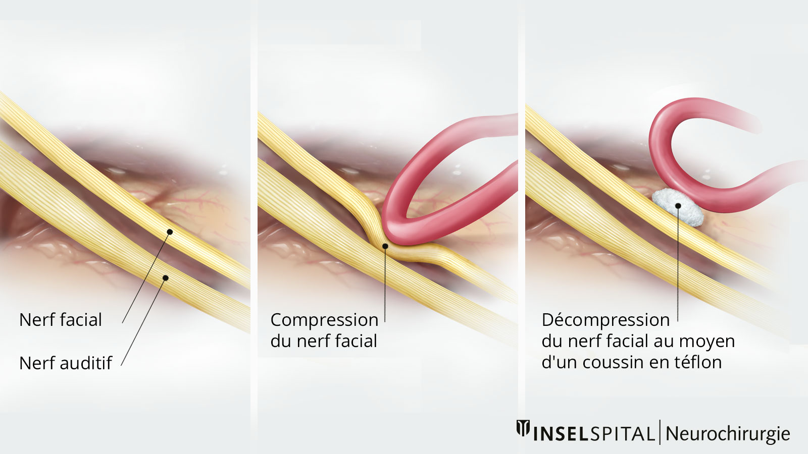 Dessin en trois parties pour la décompression du nerf facial. Un coussin en téflon est inséré entre le vaisseau sanguin et le nerf.