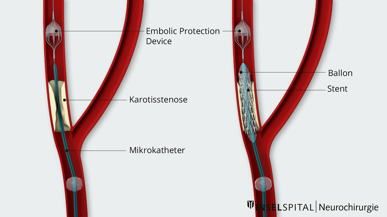 Dessin d'une dilatation par stent. A gauche, EPD (Embolic Protection Device) déployé, à droite, pose de stent et dilatation au ballonnet.