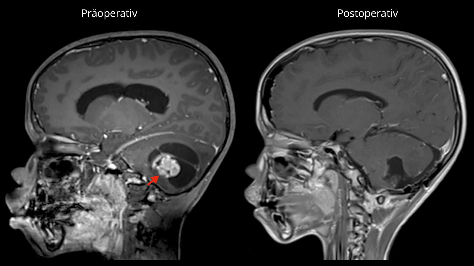 2 MRI-Aufnahmen. Links zeigt ein roter Pfeil auf den Tumor im Kleinhirnbereich. Rechts Aufnahme nach der OP ohne Tumor.