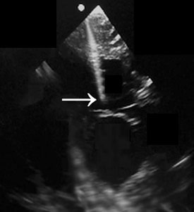 Ultrasound image of a VP shunt insertion