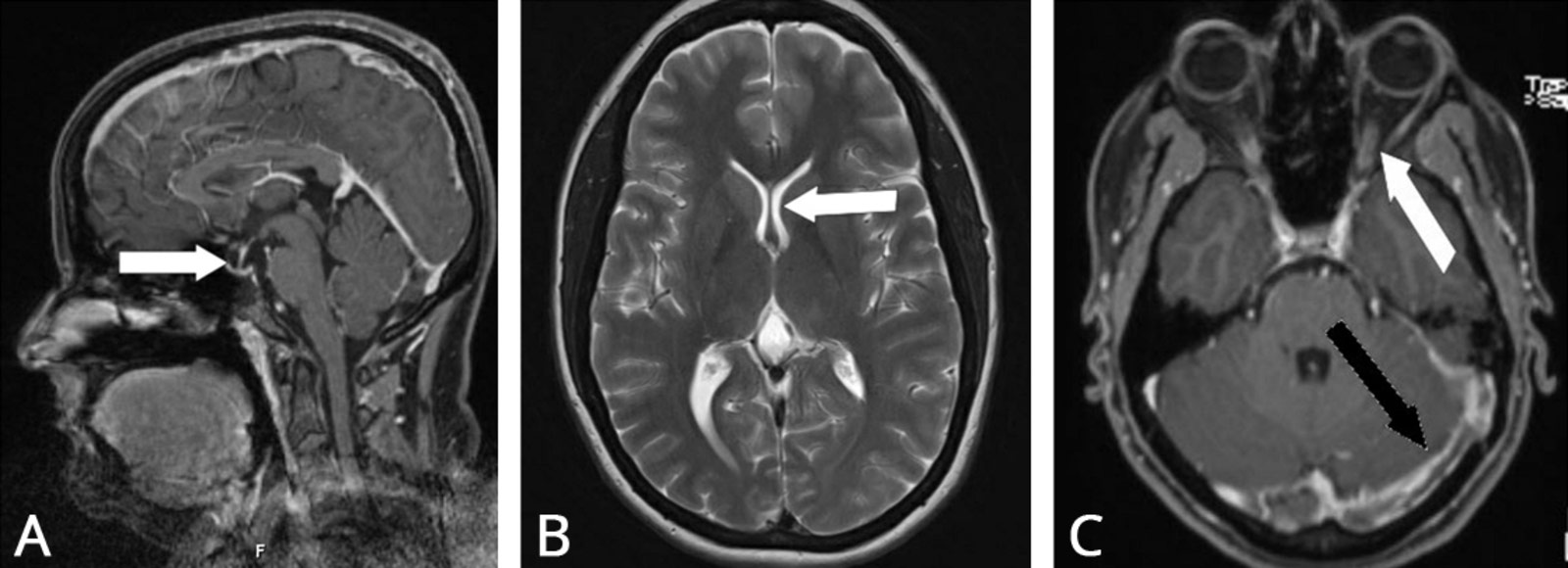Three MRI images of idiopathic intracranial hypertension with varying degrees of severity