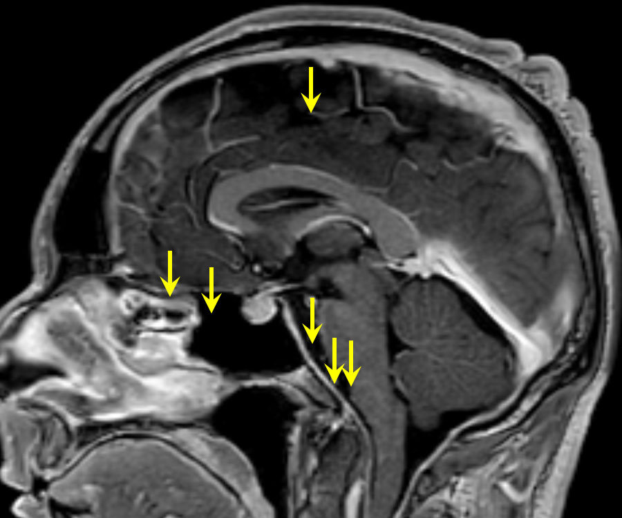 Image IRM du crâne avec affaissement du cerveau.