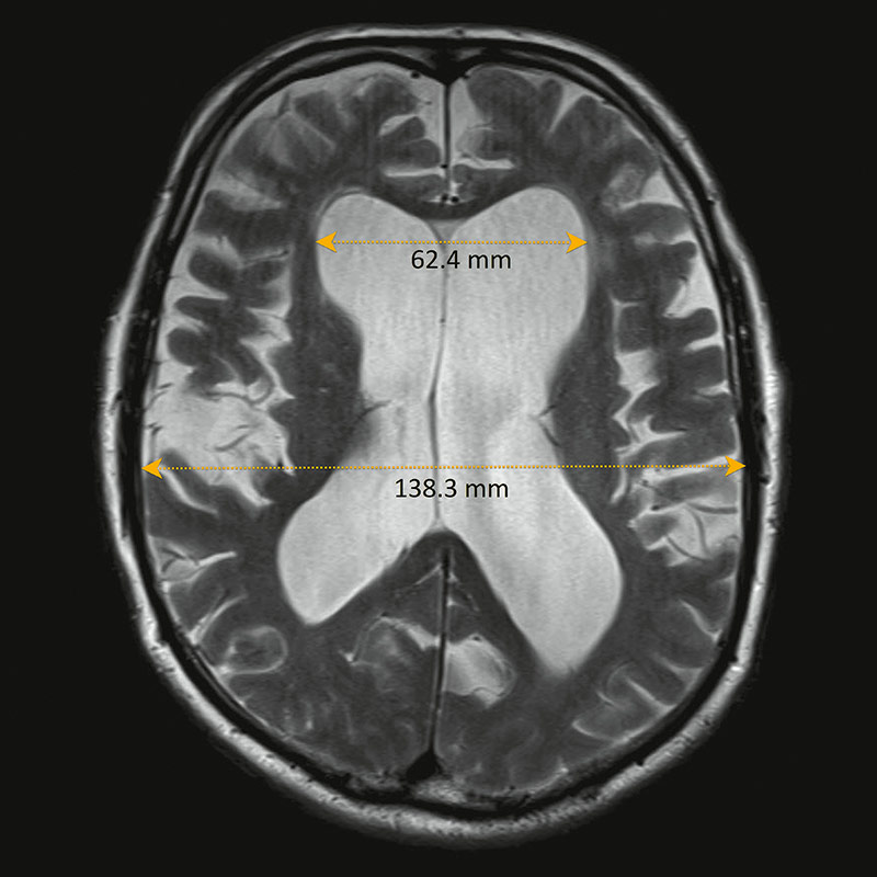​MRI eines Normaldruckhydrozephalus mit erweiterten Ventrikeln