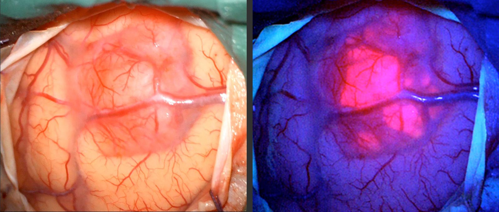 2 photos of a tumor in comparison. On the left under normal lighting and on the right under special blue light with red and pink discolored tumor tissue