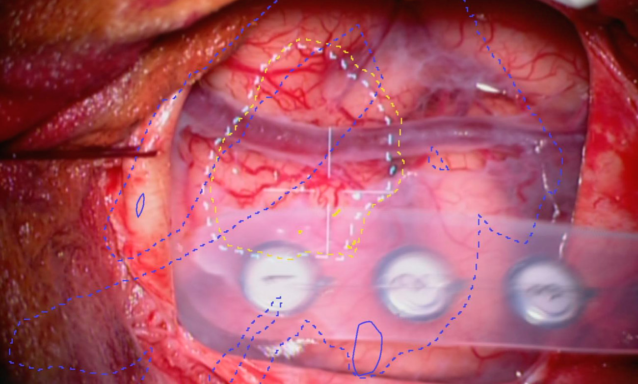 Projection of the virtual contours of a tumor and the fibers of the important trajectory onto the patient's head