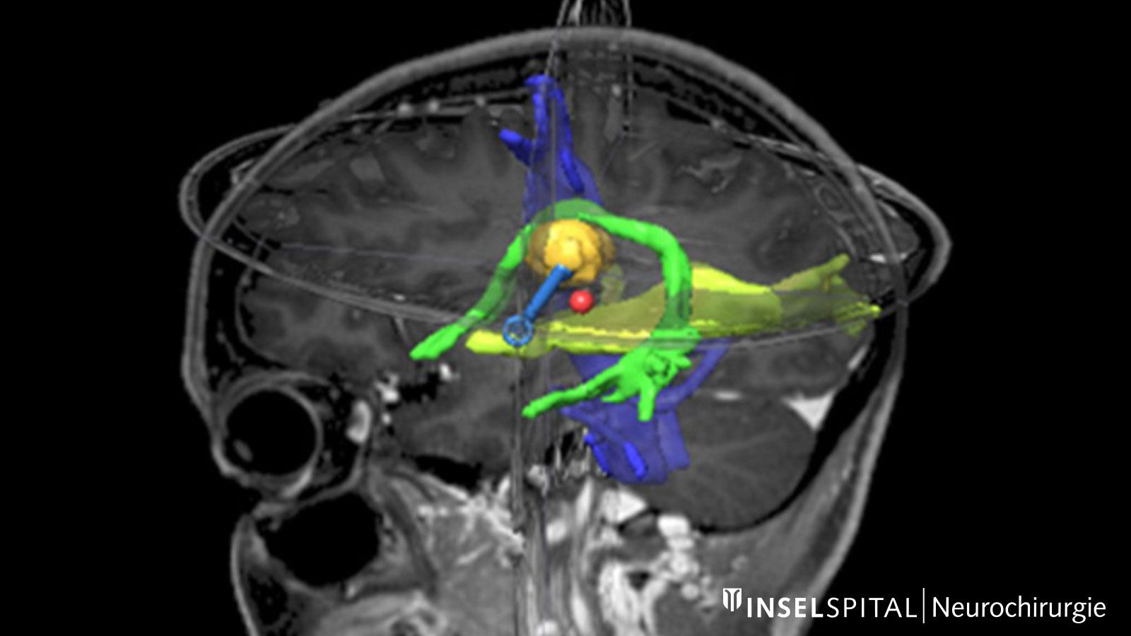 Fiber tracking image of a tumor in the middle of color-coded eloquent areas