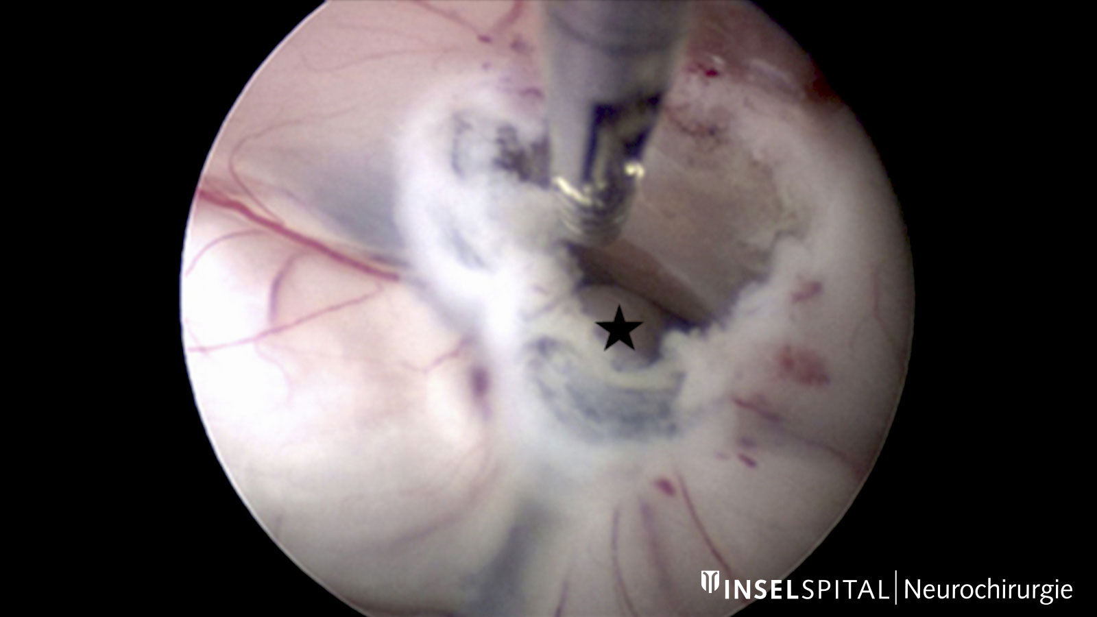 Endoscopic photo of an endoscopic third ventriculostomy for occlusive hydrocephalus