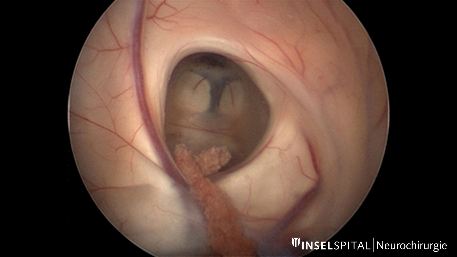 Blick durch ein Endoskop vom rechten Seitenventrikel zum 3. Ventrikel