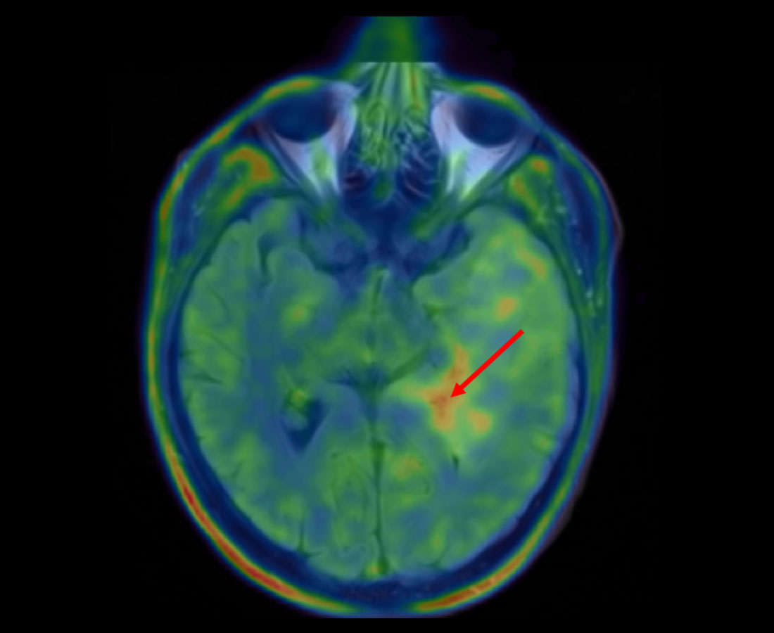 ​Farbige Bildüberlagerung von FET-PET- und MRI-Daten zeigt Hotspot im Tumor. Der ​​Bereich ist mit einem roten Pfeil markiert. 