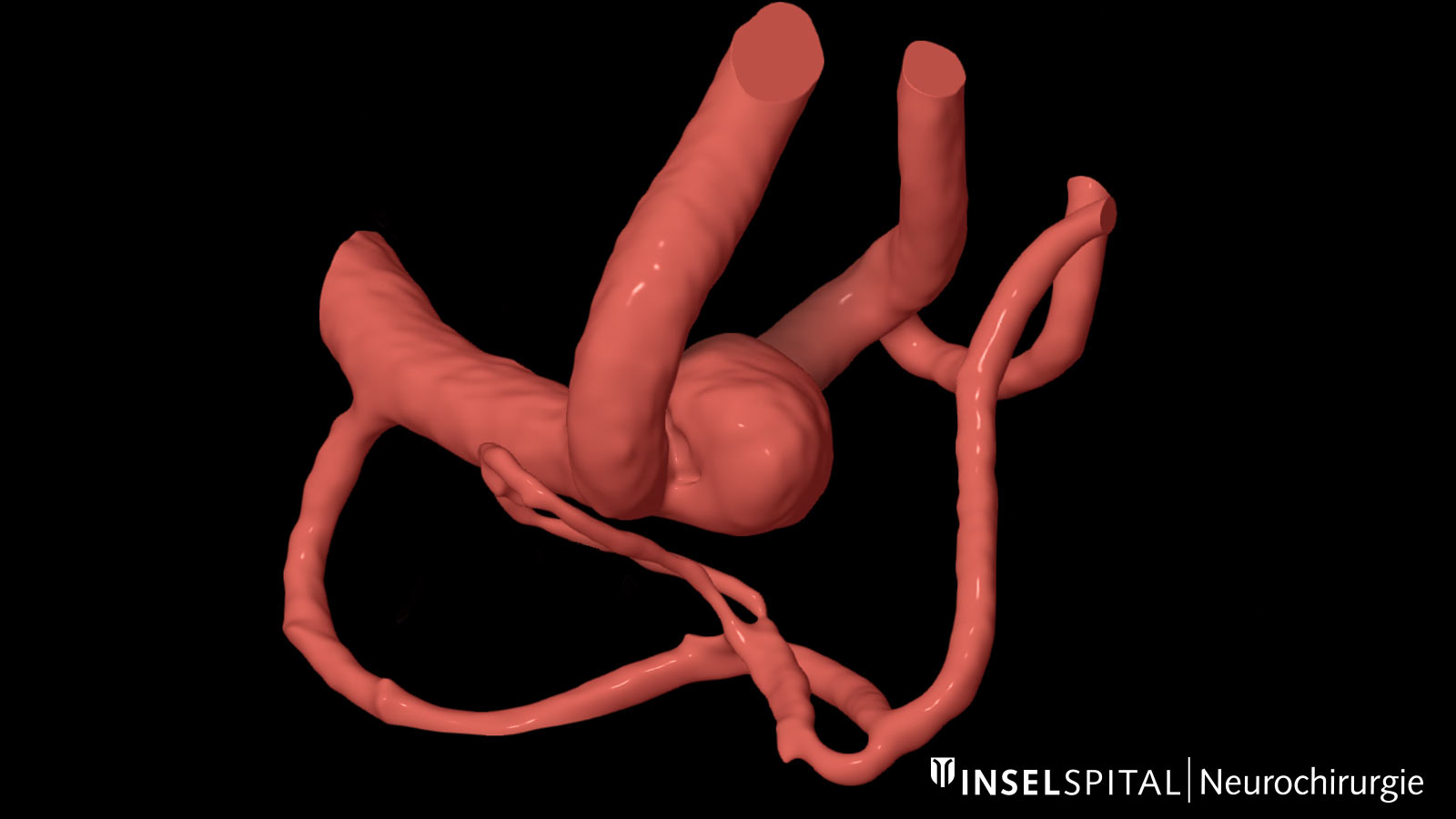 3D-Modell einer vaskulären Pathologie
