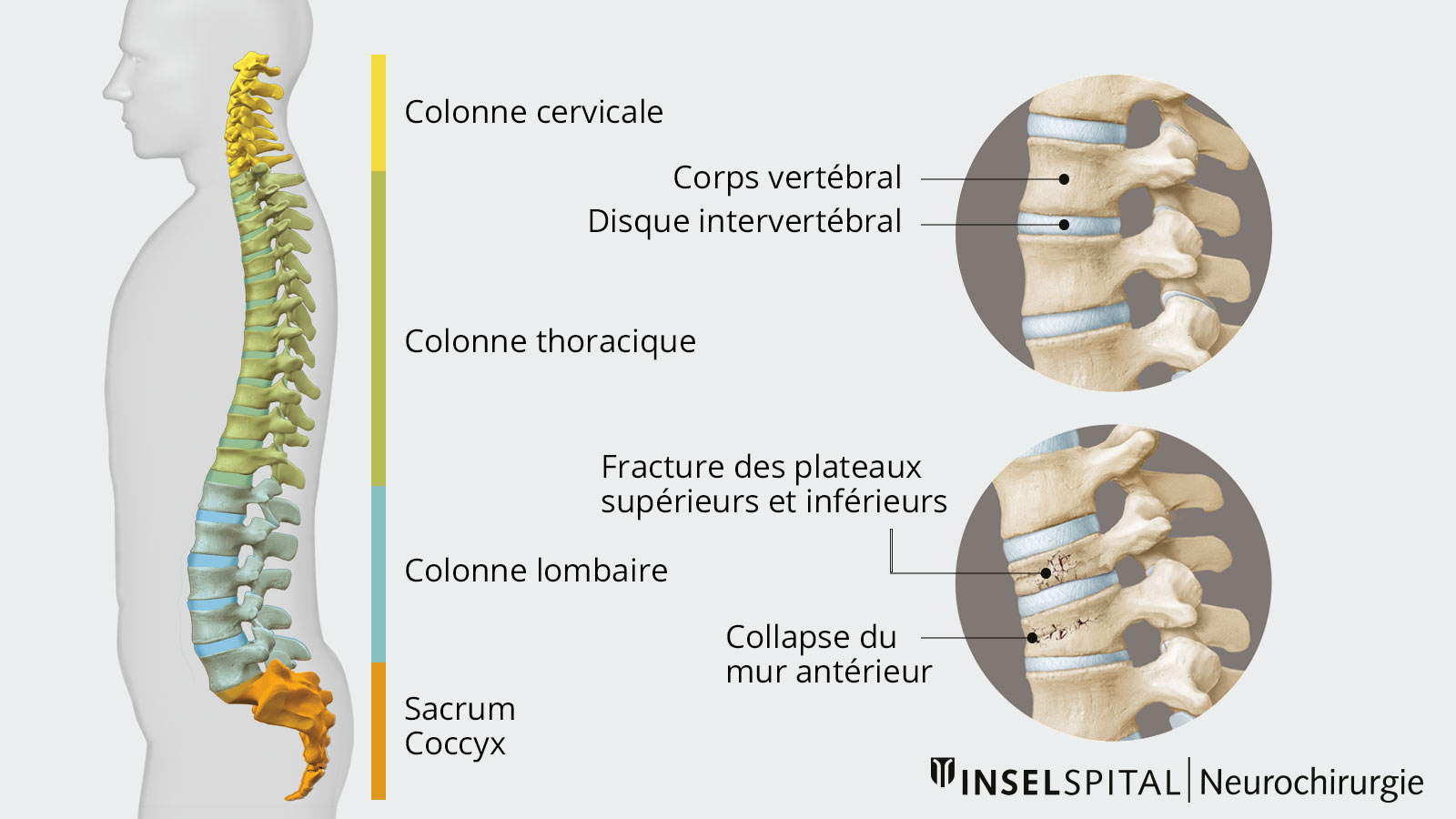Dessin de la colonne vertébrale complète vue de côté. Les différentes vertèbres sont marquées par des couleurs différentes. En vue détaillée, on voit les corps vertébraux et les disques intervertébraux ainsi que 2 types de fractures vertébrales.